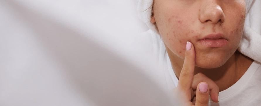 فیشال ضدآکنه