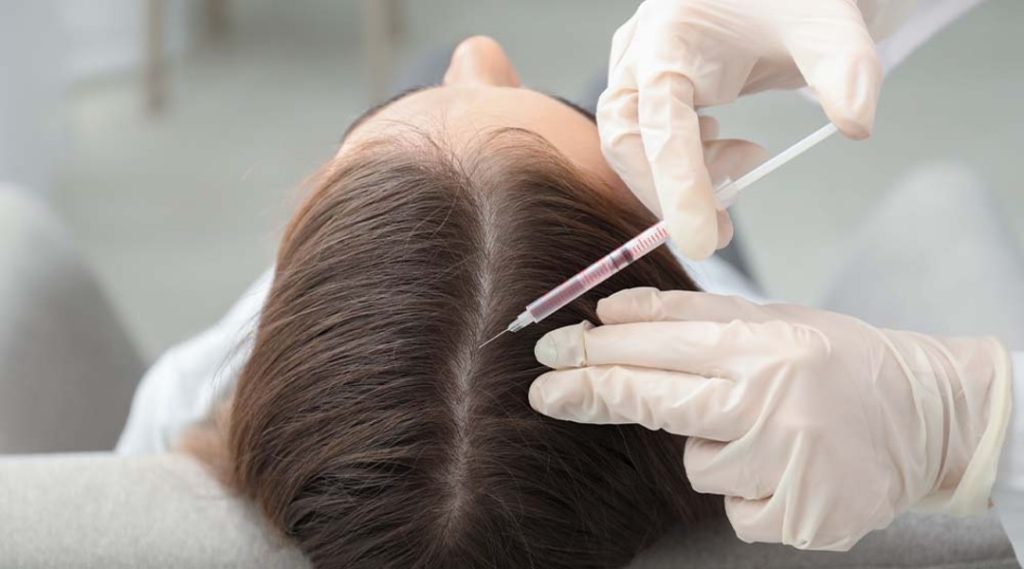 مزوتراپی مو چیست و چقدر در ریزش مو موثر است؟